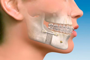 Cirugia Maxilo Facial Cirugia Maxilo Facial
