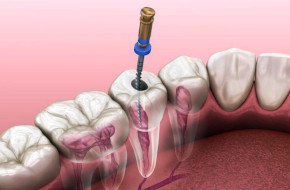 Endodoncia Endodoncia