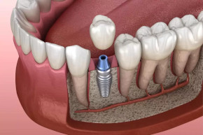 Impantes Dentales Impantes Dentales