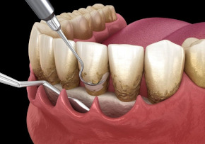 Periodoncia Periodoncia